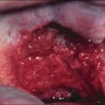 Throat Cancer Pictures