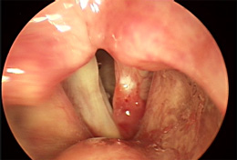 Throat Cancer Pictures