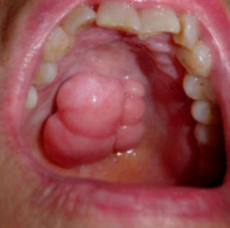 Sex glands in throat