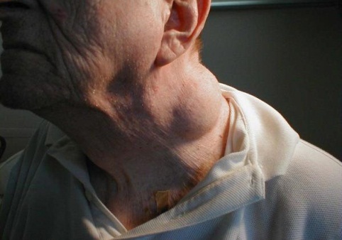 Throat Cancer Symptoms Throat Cancer Symptoms