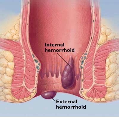 inside anus itching Deep