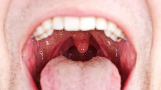 Oral Throat 65