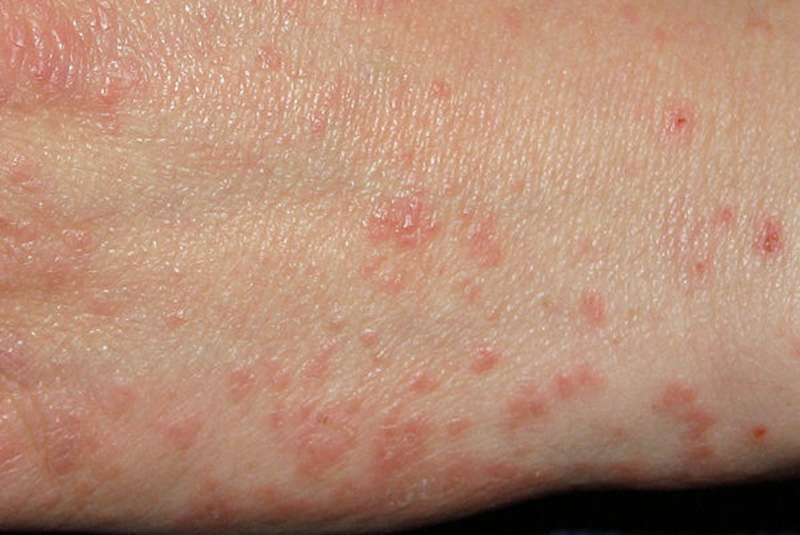 What Do Scabies Look Like? | New Health Advisor