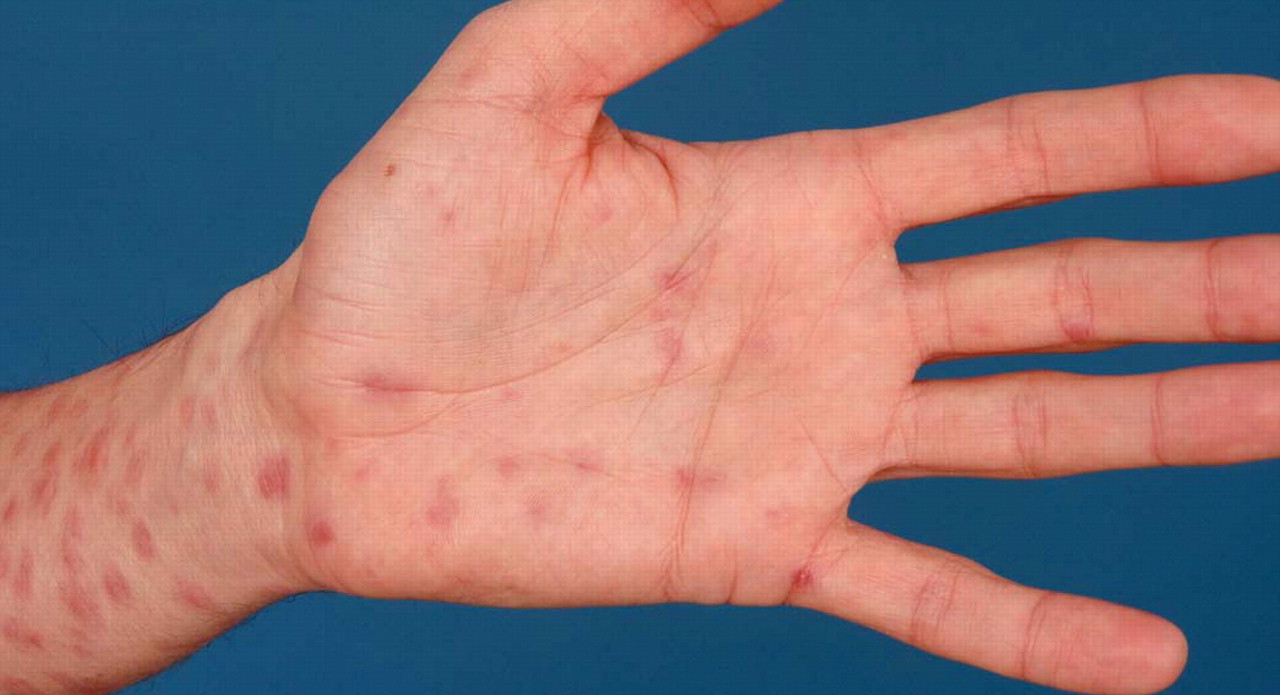 Rash On Palms Of Hands Syphilis Secondary \x3cb\x3esyphilis\x3c/b\x3e 