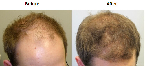  - what is metformin 500 mg used for | Does finasteride cause  more hair loss bad taste You