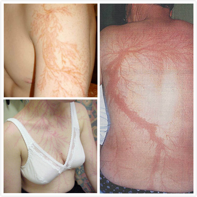 do lightning scars happen do lightning scars happen