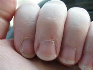 Why Is the Skin Around My Nails Peeling? | MedGuidance