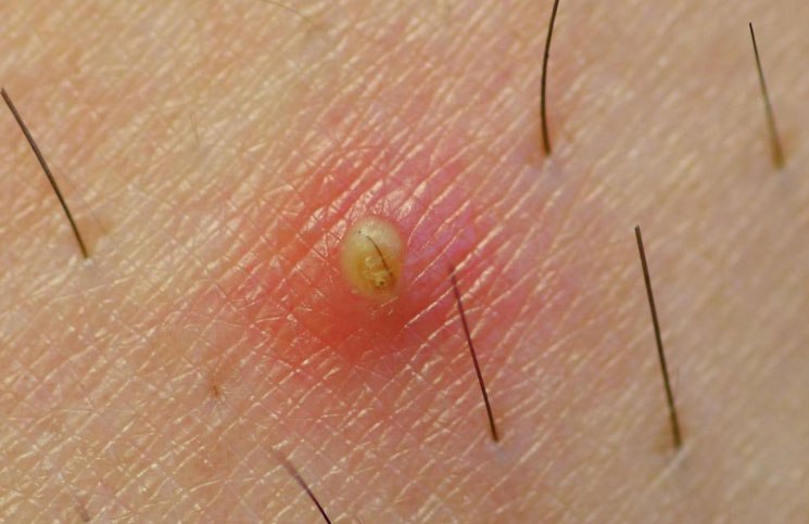 1. Causes of ingrown hair - wide 2