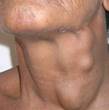Throat Cancer Pictures