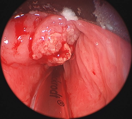 Throat Cancer Pictures