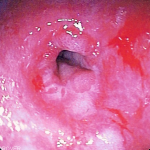 Throat Cancer Pictures