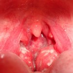 Throat Cancer Pictures