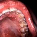 Throat Cancer Pictures